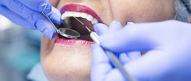 Best Knocked-Out Tooth (Avulsed Tooth) Treatment in Jonesboro, IL